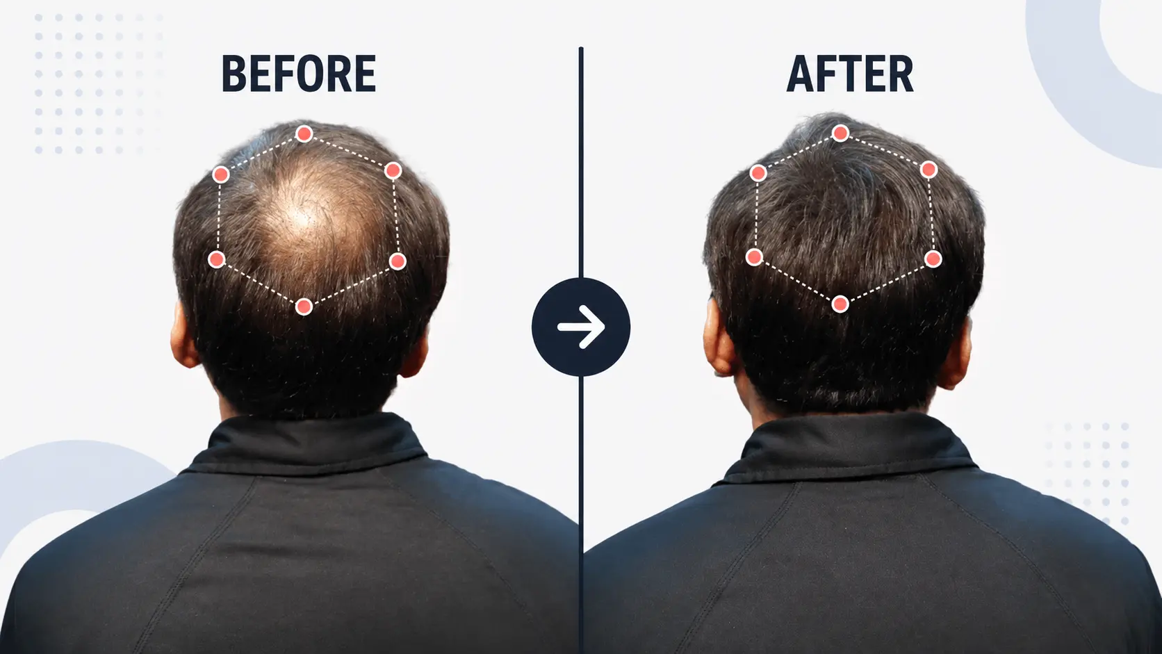 Before and after a thinning scalp covered with Super Million Hair building fibers